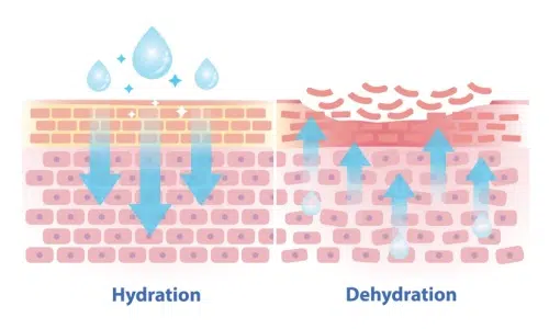 Dehydrated Skin Brisbane medical diagram