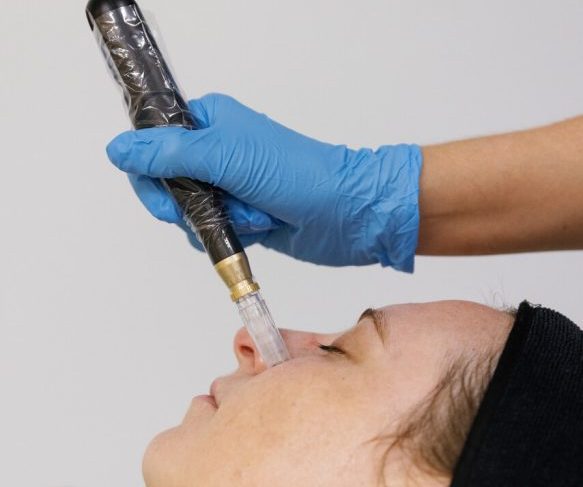 Microneedling Treatment Brisbane