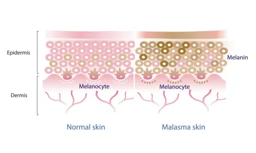 What is Melasma | Pigmentation Treatment in Brisbane