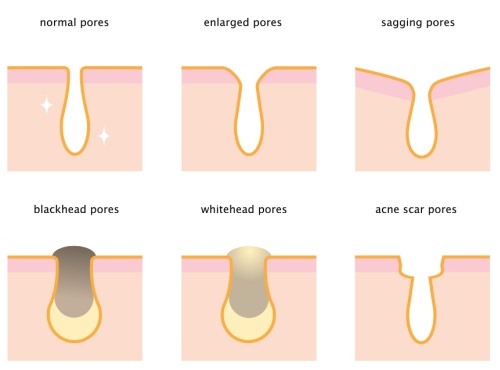 What are enlarged pores | Treatment Brisbane