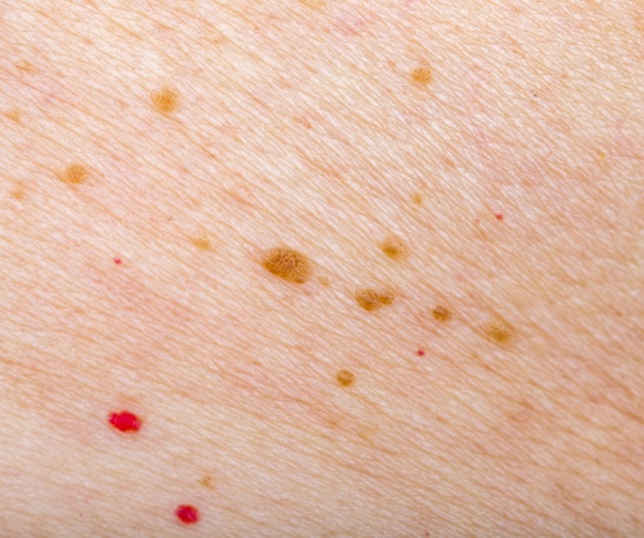 Cherry Angioma example next to other pigmentation - how to spot cherry angiomas
