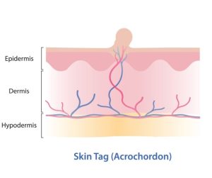 Skin Tag Removal | Brisbane