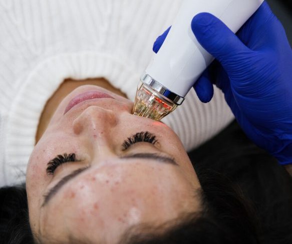 Acne Scarring Skin Treatment Package