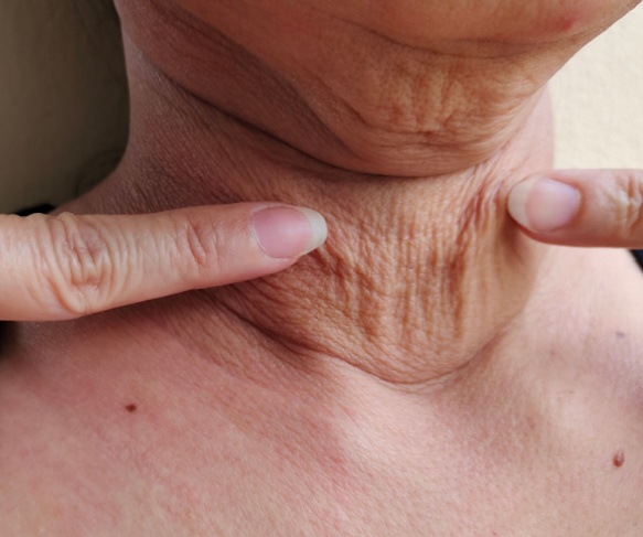 Neck Laxity targeted with RF Microneedling