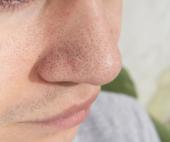 Enlarged pores or blocked pores | Treatment in Brisbane for cleansing pores and reducing pore size appearance