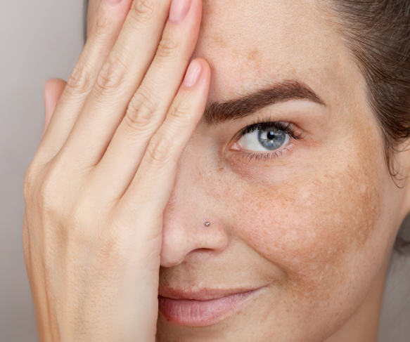 Uneven Skin Tone | Pigmented Skin