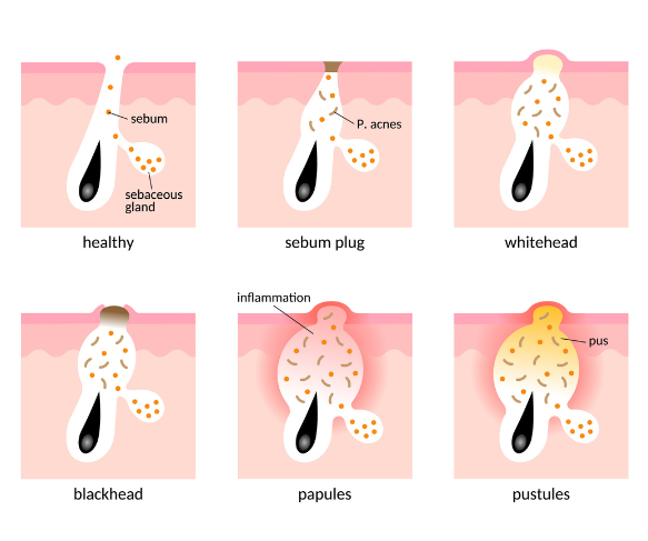How acne is formed. Knowing what kind of acne you have will help with treatment at Queensland Skin and Laser