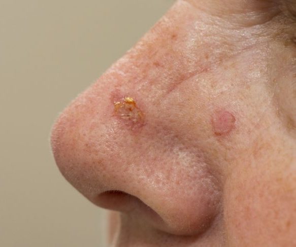 Actinic Keratosis Treatment Options