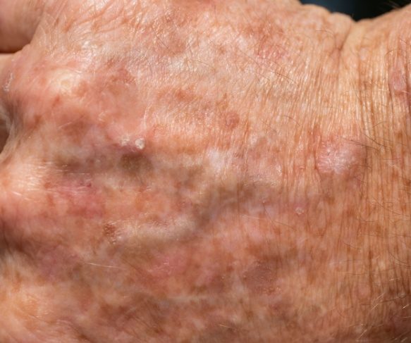 Lesions of Actinic Keratosis on hand. Treatment options available in Brisbane