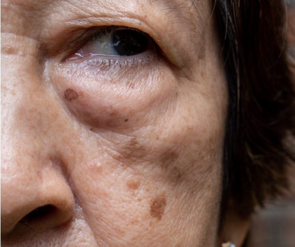 Solar Lentigines are also known as Age Spots, Sun Spots, or Liver Spots