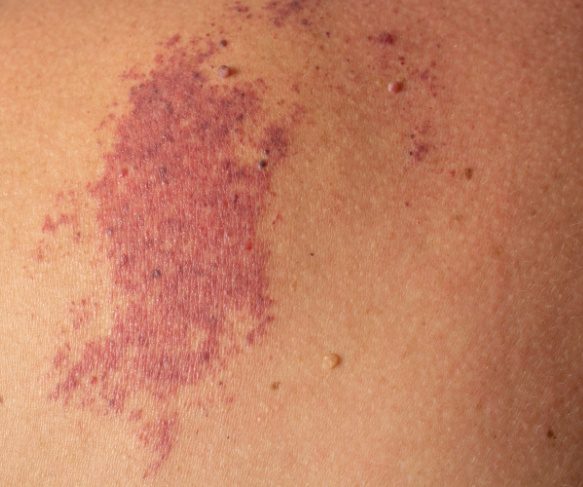 Birthmark treatment and skin assessments under our skin lesions services at Queensland Skin and Laser