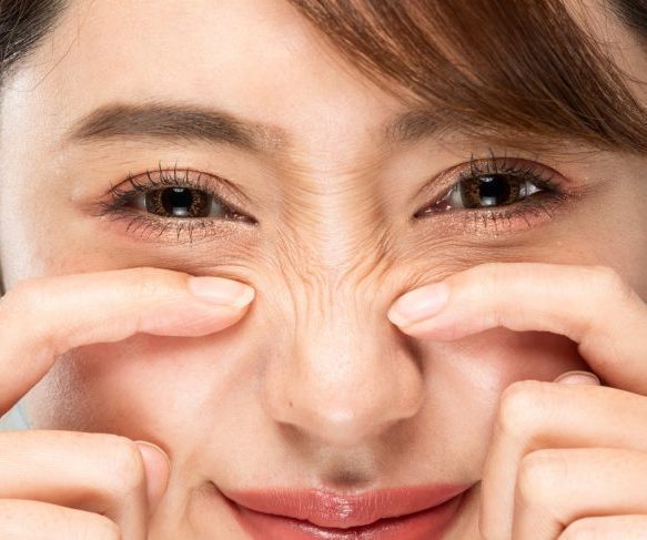 What are Bunny Lines? How can they be treated or reduced? Brisbane Skin and Laser Clinic