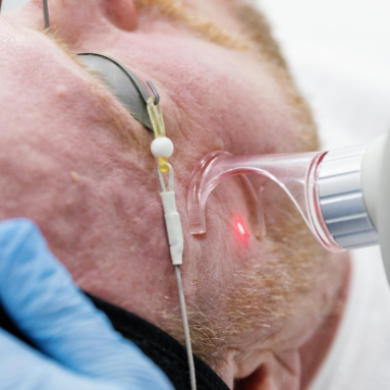 Learn more about CO2 Laser - what's the difference between ablative and fractional CO2 Laser?