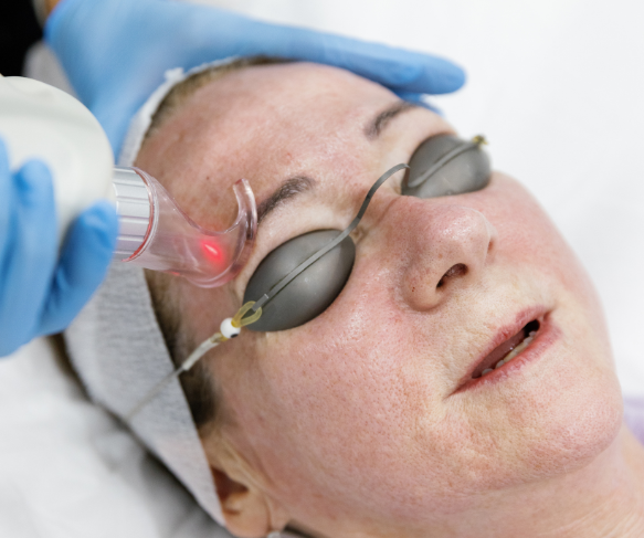 CO2 Laser resurfacing for fine lines and wrinkles, pigmentation, & skin texture concerns