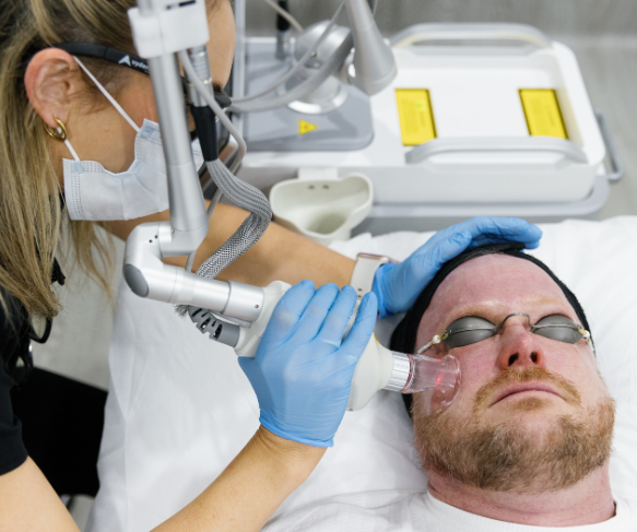 CO2 laser treatment | wrinkles, skin tone & texture, pigment, rough skin, reduce pore size appearance