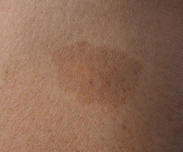 Dark brown or Cafe Au Lait Birthmark on leg of woman | Birthmark treatment available Spring Hill Brisbane
