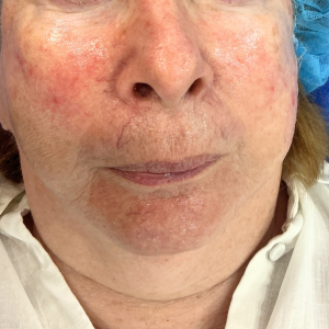 Capillaries Before 300x300