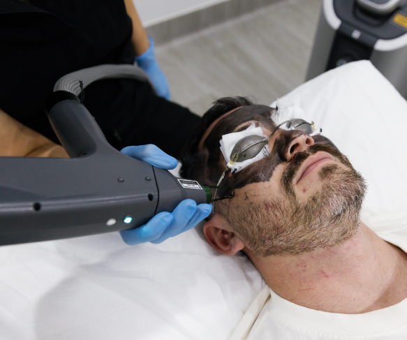 Q-Switch Laser | Carbon Facial | Pigment darker skin tone