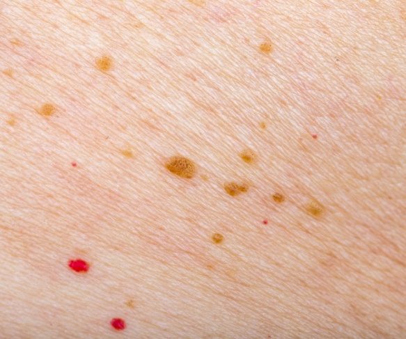Cherry Angioma example next to other pigmentation - how to spot cherry angiomas