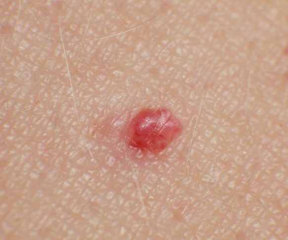 treatment for cherry angioma | Brisbane