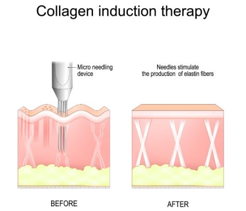 Collagen Induction Therapy