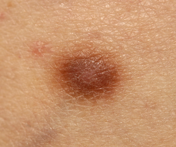 Dermatofibromas 583x487