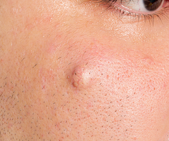 Epidermoid 583x487