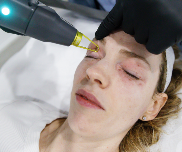 Eyelid tightening, eye area pigmentation treatment