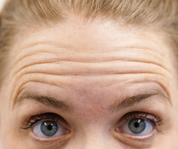 Treatment for forehead lines & wrinkles | Treatment Options wrinkles