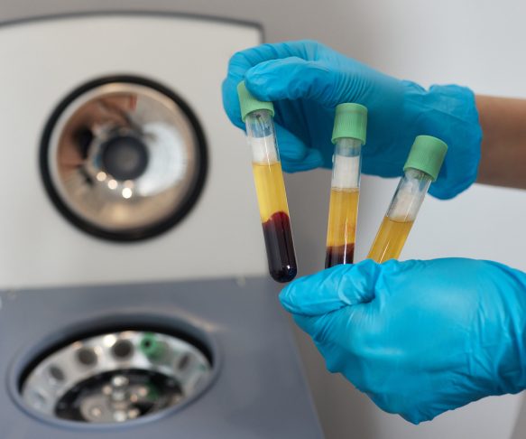 PRP PLatelet Rich Plasma or Growth Factor Therapy
