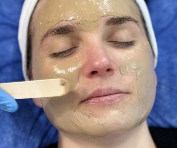 Cosmelan Peel for Melasma Treatment Brisbane