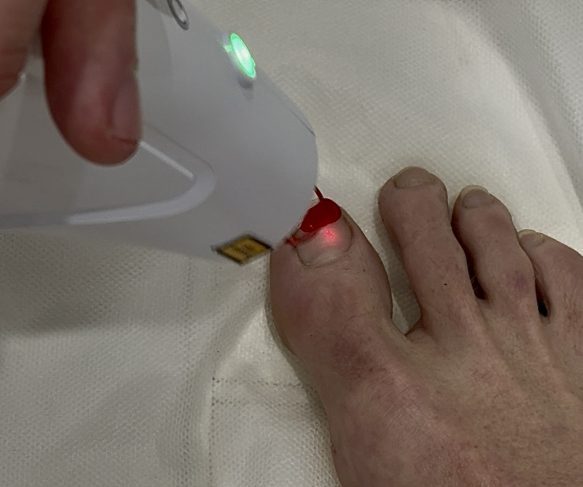 Our Laser services 1064nm Vascular Laser, Long pulse, target toenail infections