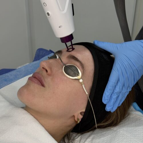1540nm Erbium Treatment Laser Options Brisbane