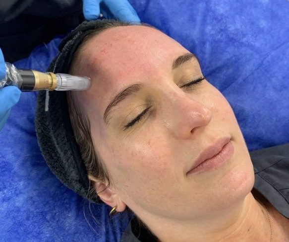 Microneedling Brisbane treatment targets fine lines, scarring, enlarged pores, uneven tone and texture