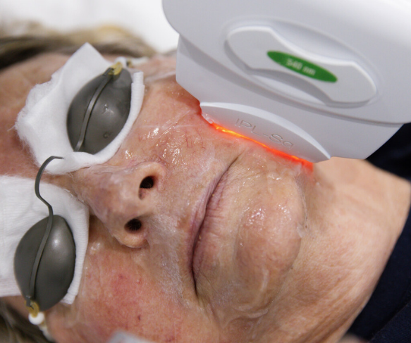 IPL for facial redness, capillaries and skin rejuvenation and tightening