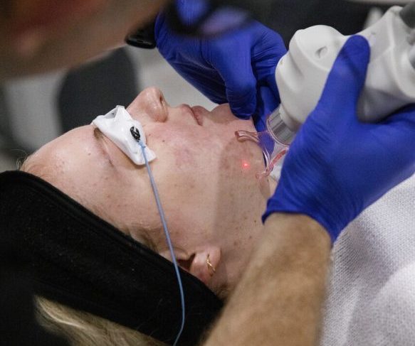 CO2 Laser resurfacing on Queensland Skin and Laser patient
