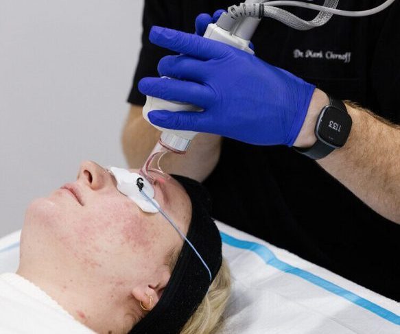 Dr Mark performing CO2 Laser Resurfacing Treatment
