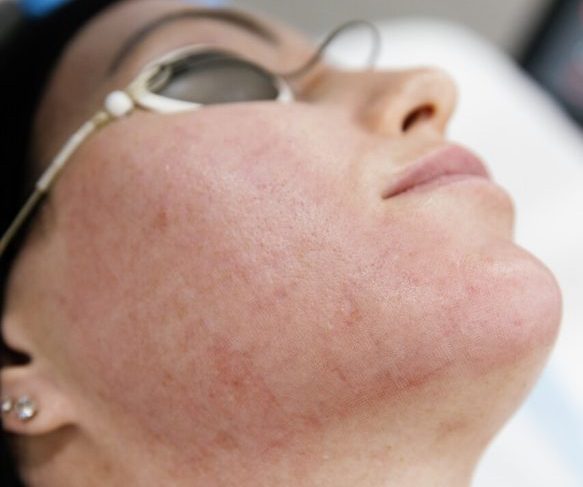 RF Microneedling + CO2 Laser Duo Service