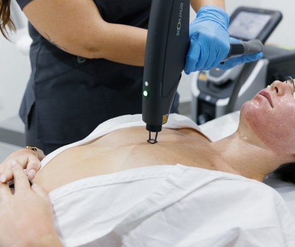 CO2 Laser resurfacing face and body scar reduction treatment Brisbane