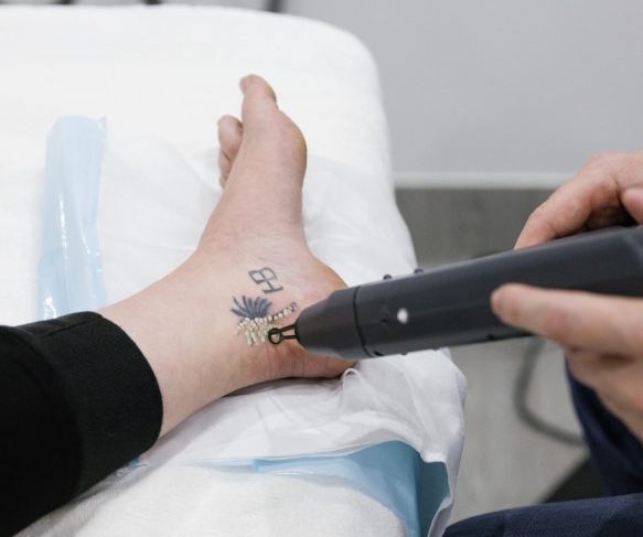 Tattoo Removal Q-Switch Laser Queensland Skin and Laser