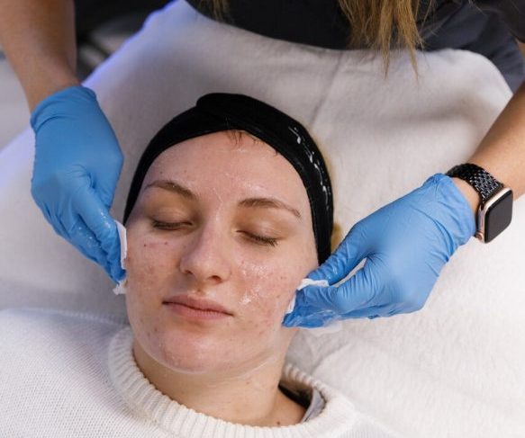 Performing a chemical peel Brisbane