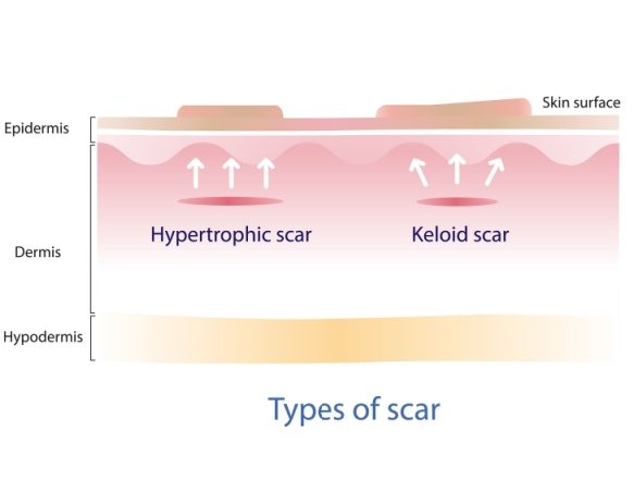 What is a keloid scar? How does a keloid scar differ from a hypertrophic scar?