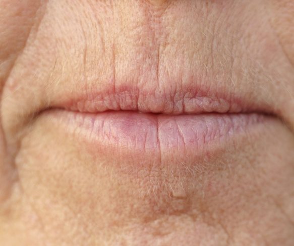 Smoker's Lines or Lip Lines: What are they and how can they be treated? Brisbane Treatment Options