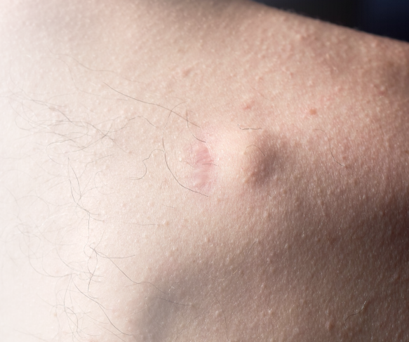 Lipoma Removal Brisbane | Treatment Options for Lipomas | What is a lipoma and what can be done to treat lipomas?