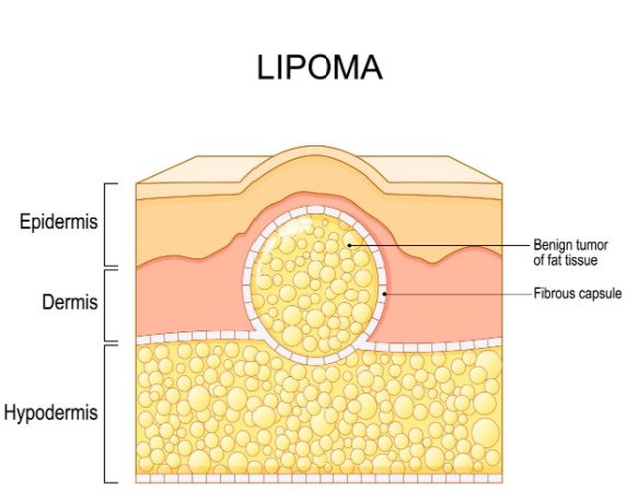 What is a lipoma? Lipomas explained. Treatment options are available at Queensland Skin and Laser