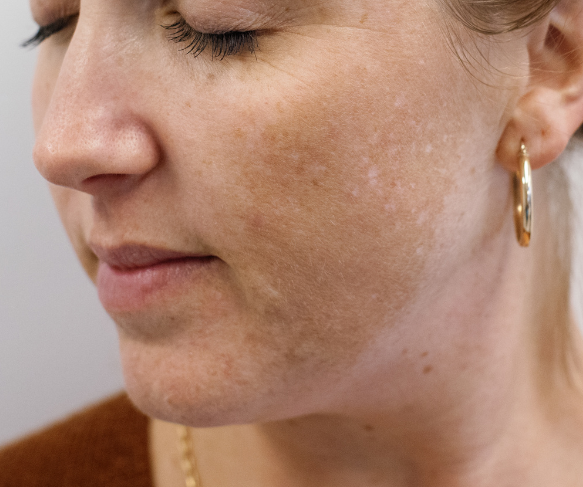 Treat melasma | manage melasma | what is melasma?