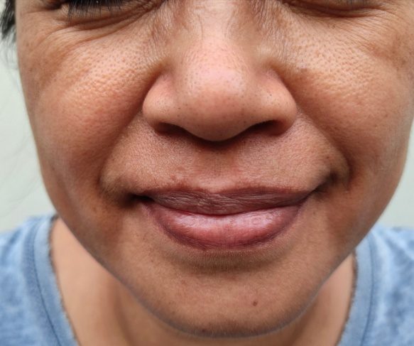 Nasolabial folds 583x487