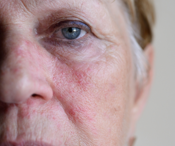 Rosacea Facial Redness 583x487