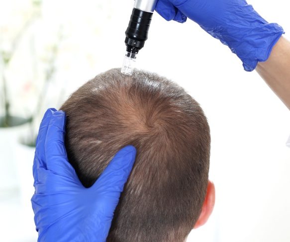 Scalp Microneedling Brisbane