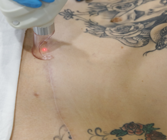 Treat scars w laser Brisbane | Scar reduction Treatment